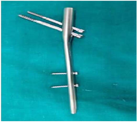 A study of functional outcome in intertrochanteric femur fractures treated by proximal femoral nailing