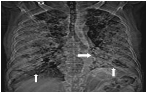 Adenocarcinoma insitu presenting as extensive crazy paving pattern: HRCT findings and review of literature