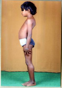 Duchenne Muscular Dystrophy in a Female Child with Turner syndrome: A Case report