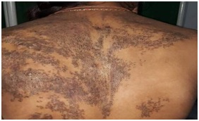 Spectrum of dermatological manifestation in all female attending tertiary health care in a developing country