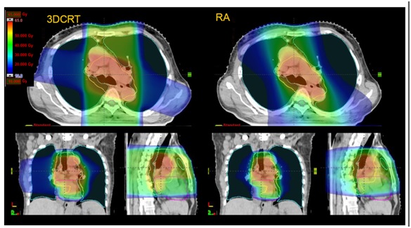 Volumetric modulated arc therapy and concurrent chemotherapy for esophageal cancers: Dosimetric comparison with 3D conformal radiotherapy and early clinical results