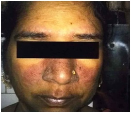 A comparative study of clinical profile & investigative parameters of systemic lupus erythematosus patients with & without metabolic syndrome