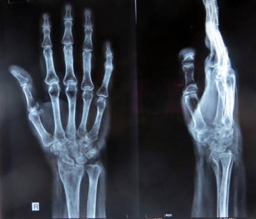 Tuberculosis of the wrist masquerading as complex regional pain syndrome type 1: A diagnostic dilemma