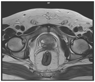 Role of Multiparametric MRI in Diagnosis of Prostate Cancer