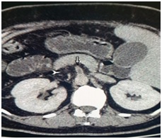 Endovascular Management of Acute Superior Mesenteric Artery Thrombosis in a Delayed Setting