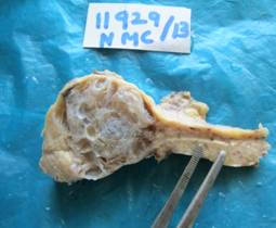Pancreatic serous cystadenoma – A case report