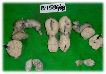 Bilateral Primary Fallopian Tube Adenocarcinoma – A Rare Case