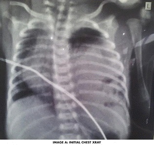 Congenital Diaphragmatic Hernia: Atypical Early X-Ray Presentation