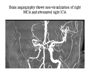 Stroke as the initial manifestation of Takayasu’s arteritis: a Case report