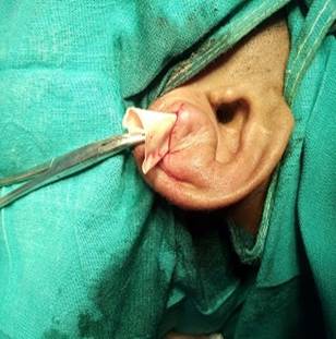Management of Auricular Pseudocyst: A Comparative Study