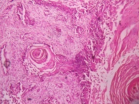 Squamous cell carcinoma of the breast – A rare entity