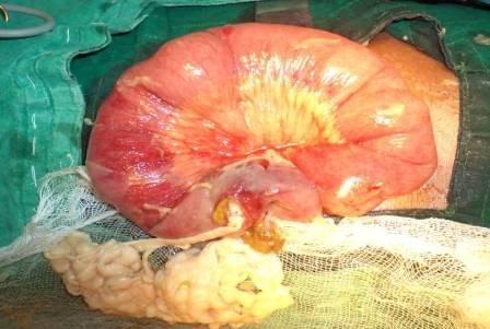 Ileal Perforation Peritonitis Caused By T. Saginata:  A Case Report