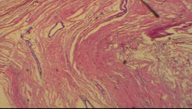 A Rare Case of Huge Unilocular Autoamputated Extra-ovarian Dermoid Cyst