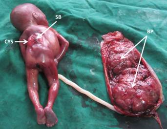 Prenatally Diagnosed Type II Arnold Chiari Malformations-A Rare Congenital Anomaly with Some Unusual Associated Defects