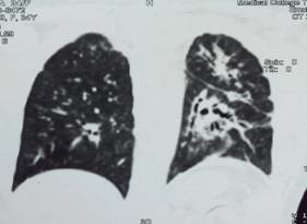 Hermansky–Pudlak Syndrome a Case Report