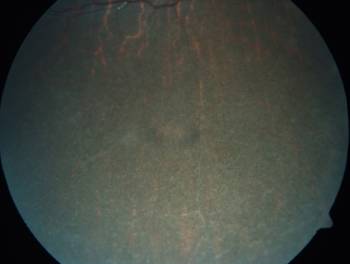 Laurence- Moon- Bardet- Biedle Syndrome – A Case Report