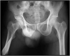 Titanium Reconstruction Nailing For Sub - Trochanteric Fractures of Femur