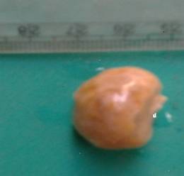 Calcified Mesenteric Cyst- An Unusual Presentation as Strangulated Umbilical Hernia