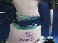 Modified pre-surgical technique for optimizing the mandibular deviation using gunning’s splint as discontinuity mandibulectomy prosthesis: A Case Report