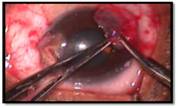 Exchange conjunctival autograft in double pterygium