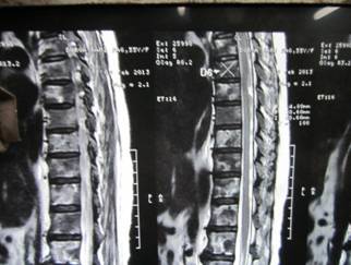 Case of Gastric Adenocarcinoma Presenting as Microangiopathic Hemolytic Anemia (MAHA) and secondary Myelofibrosis with vertebral Metastasis