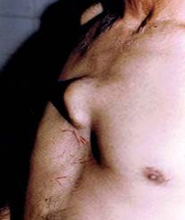 Role of Surgical Biopsy in Thoracic Swellings