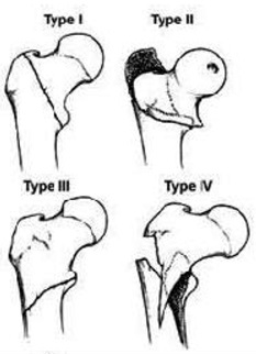 Titanium proximal femoral nailing for inter-trochanteric fractures of femur