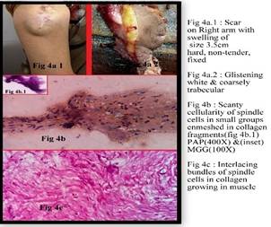 Cytology of lesions arising in and around operative scars: short series of four cases
