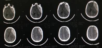Urgency for surgical evacuation of post traumatic Intracranial acute epidural hematoma