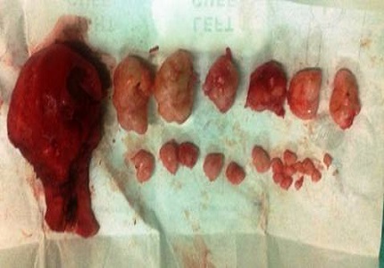 Nondescent vaginal hysterectomy, a changing practice in Indian scenario for scar less surgery