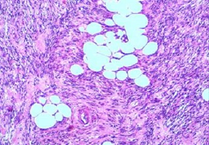 Uterine Lipoleiomyoma