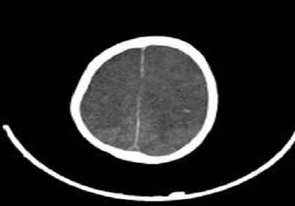 Plasmodium vivax malaria with thrombocytopenia presenting as Subarachnoid Hemorrhage in an elderly male