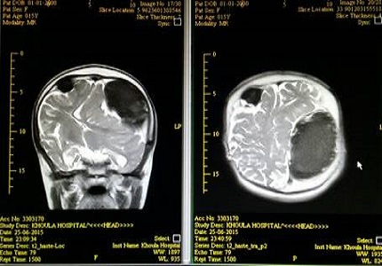 A rare case of large bilateral epidural hematoma following ventriculoperitoneal shunt: a case report with review of literature