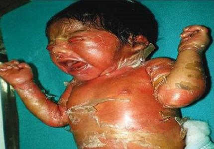 A rare case report on colloidion baby syndrome with severe ectropion in neonates