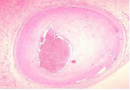 Neovascularization in Advanced Atherosclerosis - A Histomorphometric Study
