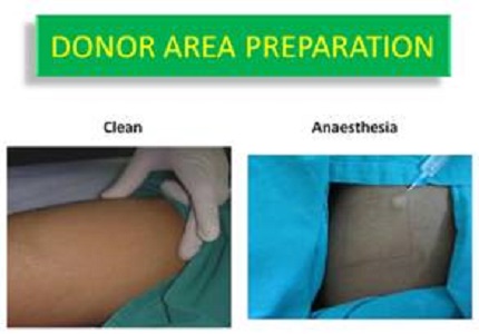 Randomized control trial to compare the efficacy of split thickness transplant versus autologous melanocyte transplant in the management of stable vitiligo