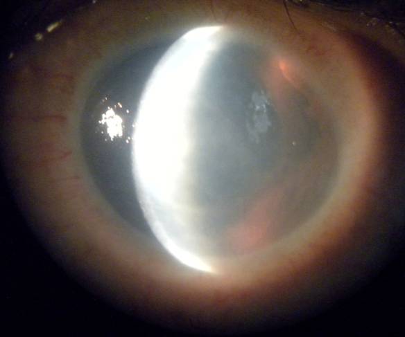 Iridocorneal endothelial syndrome: Cogan -Reese syndrome. A case report