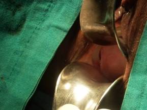 A retained Pessary in a 65 year old woman: Case Report
