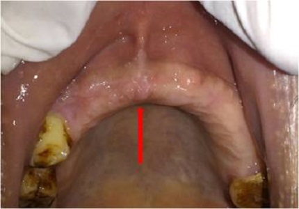 A rare case report on atypical odontalgia with psychological implications