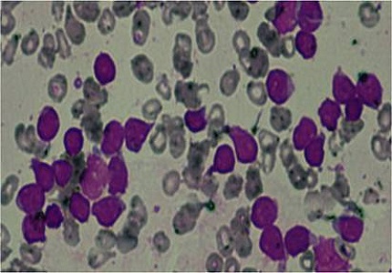 Rare Entities of Mixed Phenotypic Acute Leukemia: Are They Really So Rare? Largest Series of B+T MPAL
