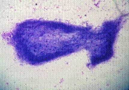 Role of FNAC in the diagnosis of cysticercosis