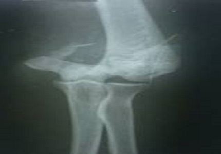 Outcome analysis of intercondylar humerus fractures treated by locking compression plates