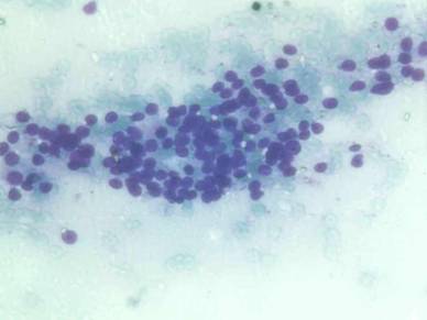 Trends in Cytomorphological Study of Thyroid lesions: A two year prospective study in the malwa region of central India