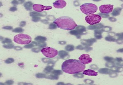 Flow immunophenotyping features of crisis phase of chronic myeloid leukemia in childhood: do we really care?