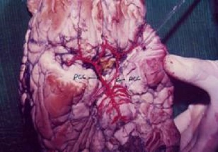 Study of variations in posterior communicating artery in human brain