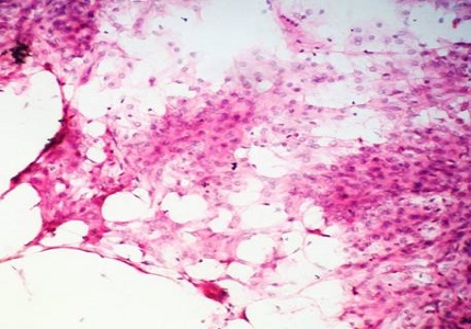Clinicopathological Study of Meningioma