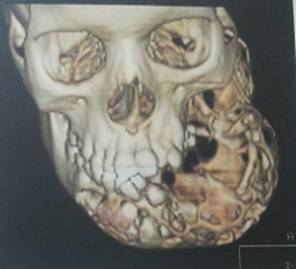 An unusual case of a very large Ameloblastic fibroma
