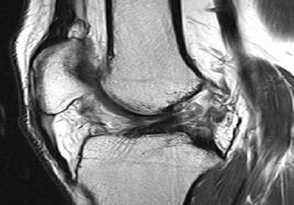 High field 3T magnetic resonance imaging:  MR-anatomy evaluation of traumatic knee injuries