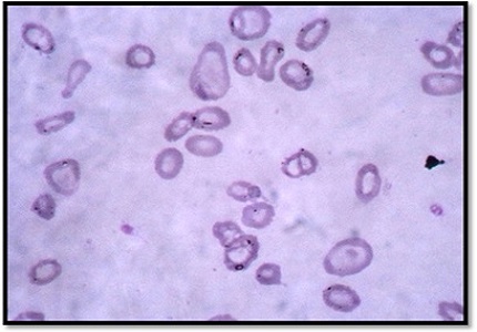 Pancytopenia- A clinicopathological analysis of 132 cases