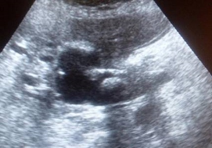 Comparison of computed Tomography and ultrasonography in evaluating causes of obstructive jaundice